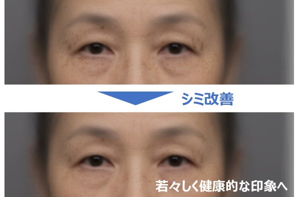 シミ部位と対人印象の関係を解明　目まわりのシミ改善により若々しく健康的な印象へ