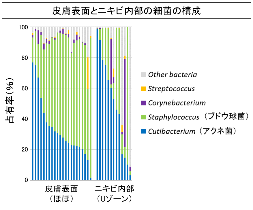 ニキビの内部には多様な菌が生息していることを遺伝子レベルで解明