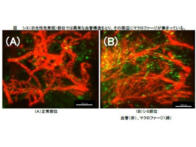 資生堂、シミの肌内部における血管構造異常の3D可視化に成功