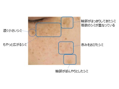 シミができる原因はひとつじゃない　シミ悩みは100人100様。美白ケアの正解は？　一つの成分対応ではあなたのシミ予防にはつながらない？！