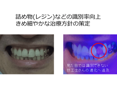 これからの予防に、お口をキレイにするための「染め出しライト」×「デンタルミラー」で口腔ケアを強化
